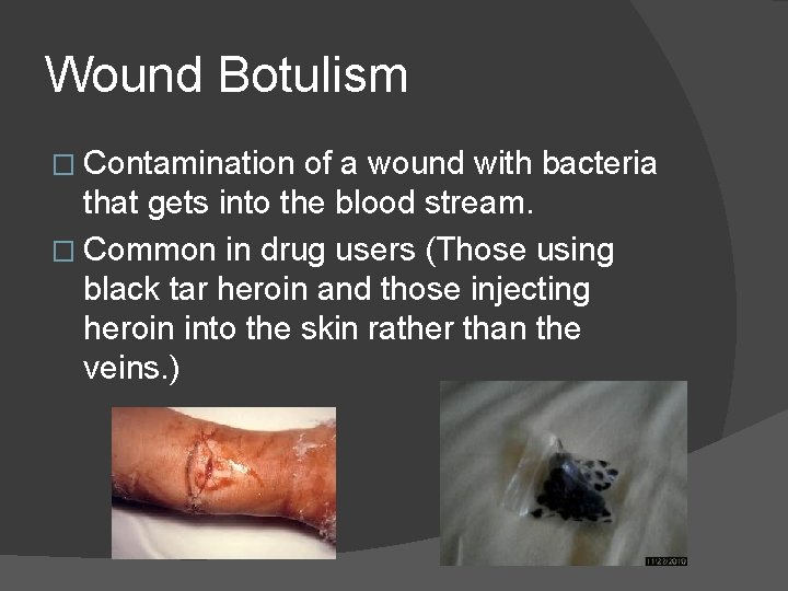 Wound Botulism � Contamination of a wound with bacteria that gets into the blood