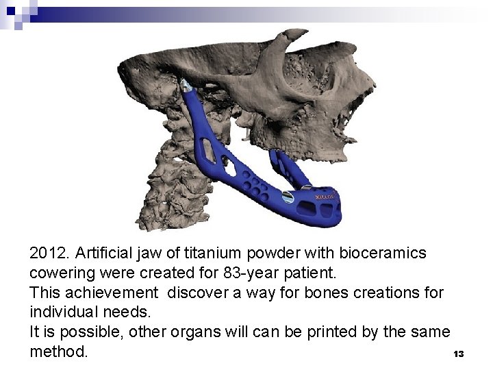 2012. Artificial jaw of titanium powder with bioceramics cowering were created for 83 -year