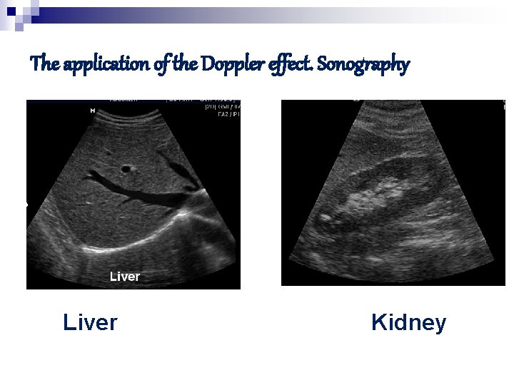 The application of the Doppler effect. Sonography Liver Kidney 