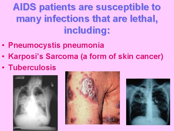 AIDS patients are susceptible to many infections that are lethal, including: • Pneumocystis pneumonia