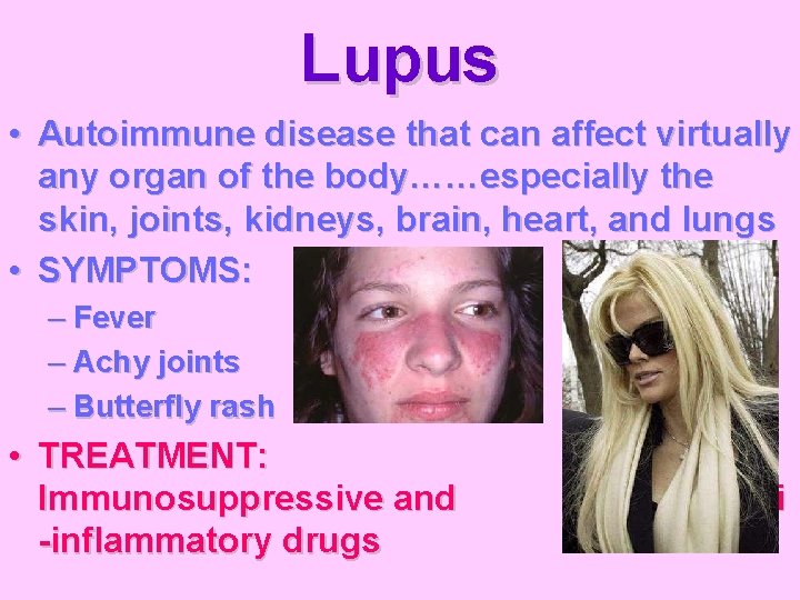 Lupus • Autoimmune disease that can affect virtually any organ of the body……especially the