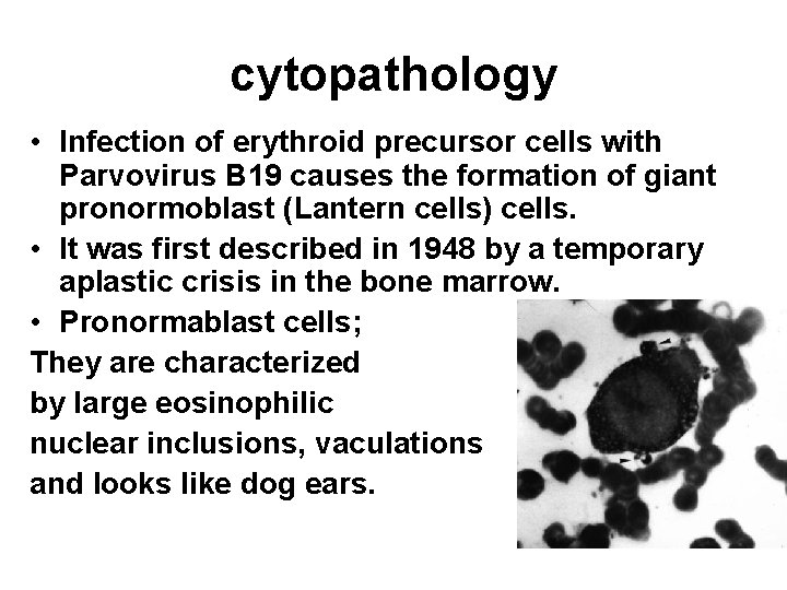 cytopathology • Infection of erythroid precursor cells with Parvovirus B 19 causes the formation