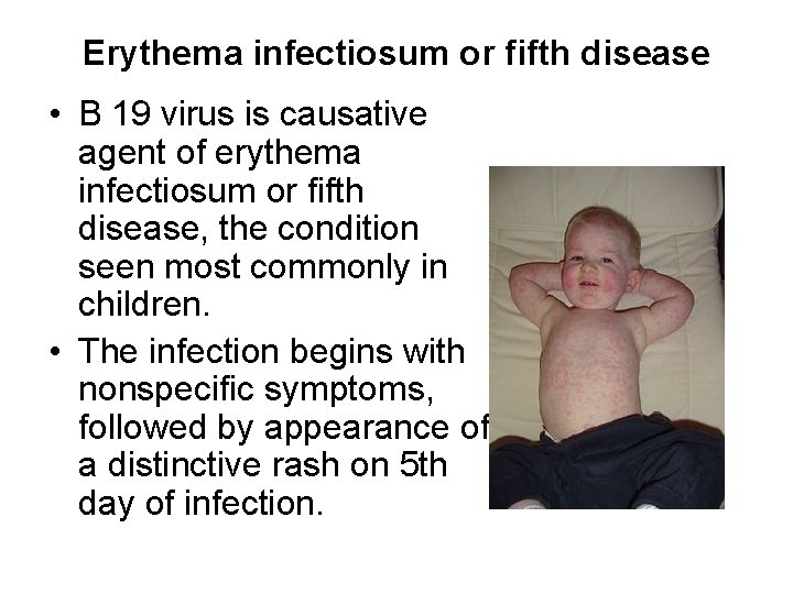 Erythema infectiosum or fifth disease • B 19 virus is causative agent of erythema