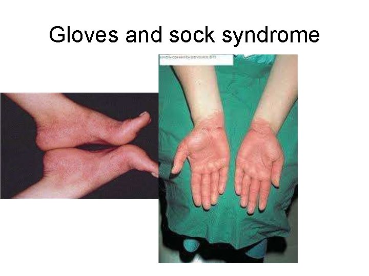 Gloves and sock syndrome 
