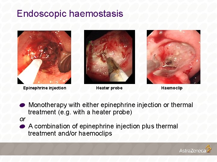 Endoscopic haemostasis Epinephrine injection or Heater probe Haemoclip Monotherapy with either epinephrine injection or