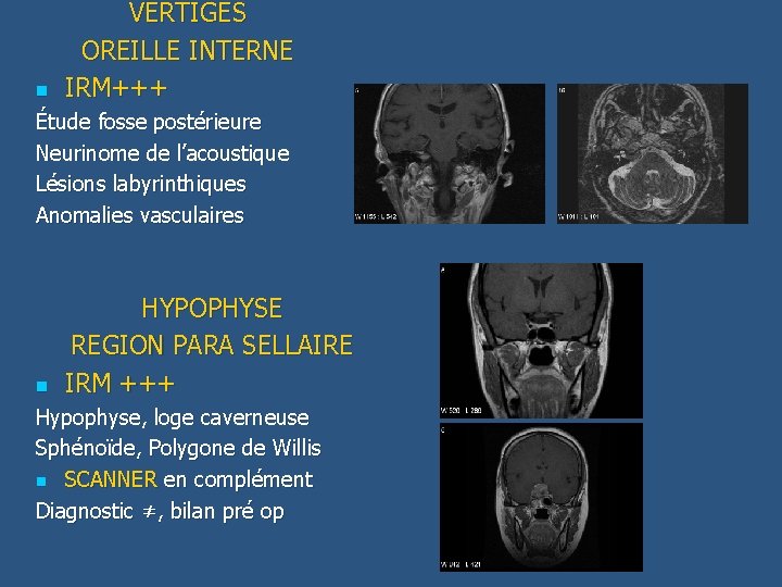 n VERTIGES OREILLE INTERNE IRM+++ Étude fosse postérieure Neurinome de l’acoustique Lésions labyrinthiques Anomalies