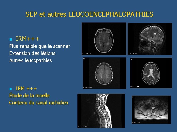 SEP et autres LEUCOENCEPHALOPATHIES n IRM+++ Plus sensible que le scanner Extension des lésions
