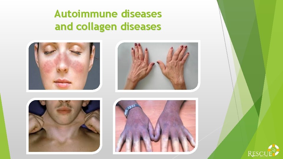 Autoimmune diseases and collagen diseases 