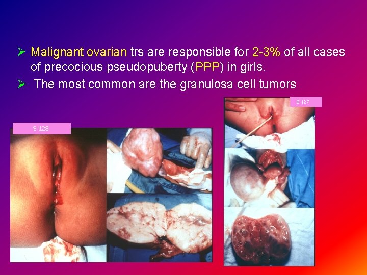 Ø Malignant ovarian trs are responsible for 2 -3% of all cases of precocious