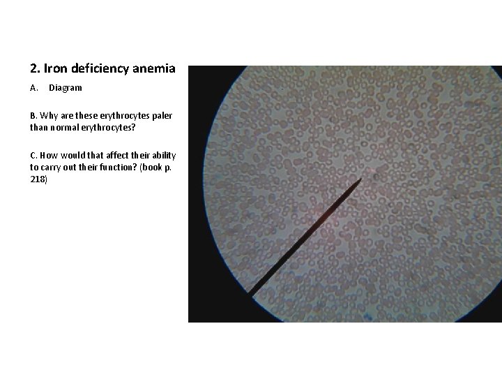 2. Iron deficiency anemia A. Diagram B. Why are these erythrocytes paler than normal