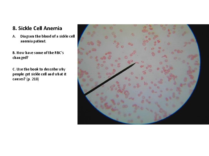 8. Sickle Cell Anemia A. Diagram the blood of a sickle cell anemia patient.