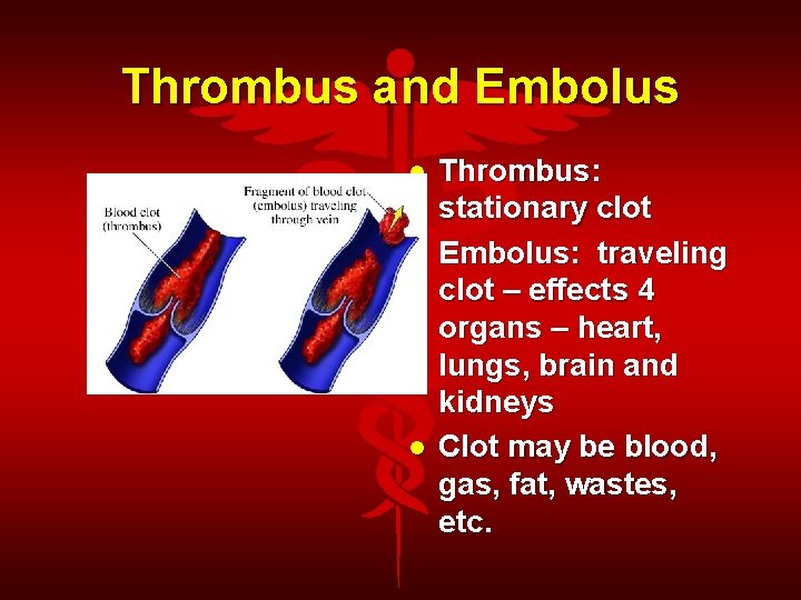Thrombus and Embolus Thrombus: stationary clot Embolus: traveling clot – effects 4 organs –