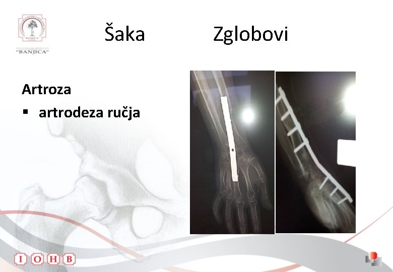 Šaka Artroza § artrodeza ručja Zglobovi 