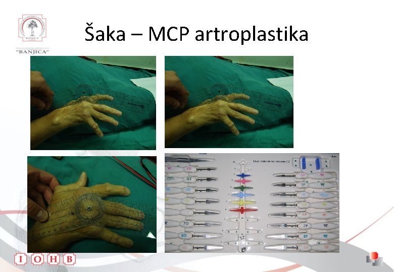 Šaka – MCP artroplastika 