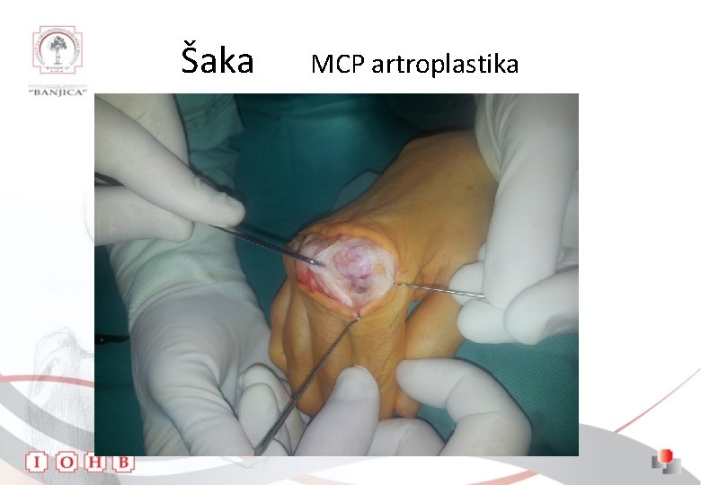 Šaka MCP artroplastika 