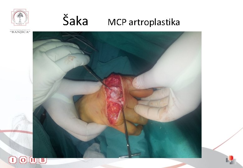 Šaka MCP artroplastika 