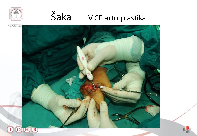 Šaka MCP artroplastika 