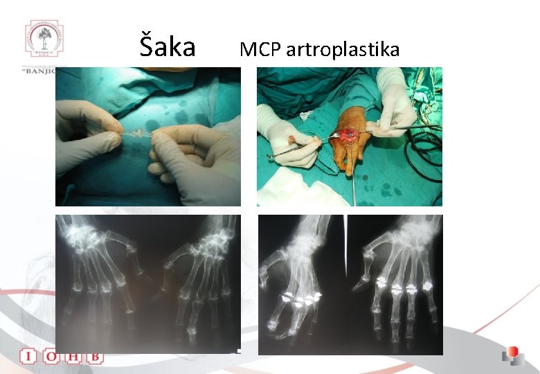 Šaka MCP artroplastika 