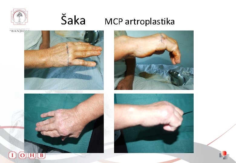 Šaka MCP artroplastika 