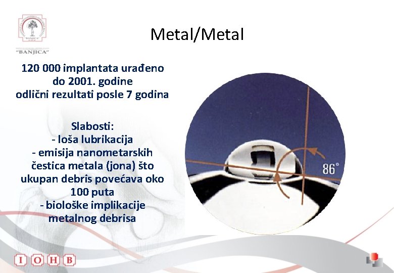 Metal/Metal 120 000 implantata urađeno do 2001. godine odlični rezultati posle 7 godina Slabosti: