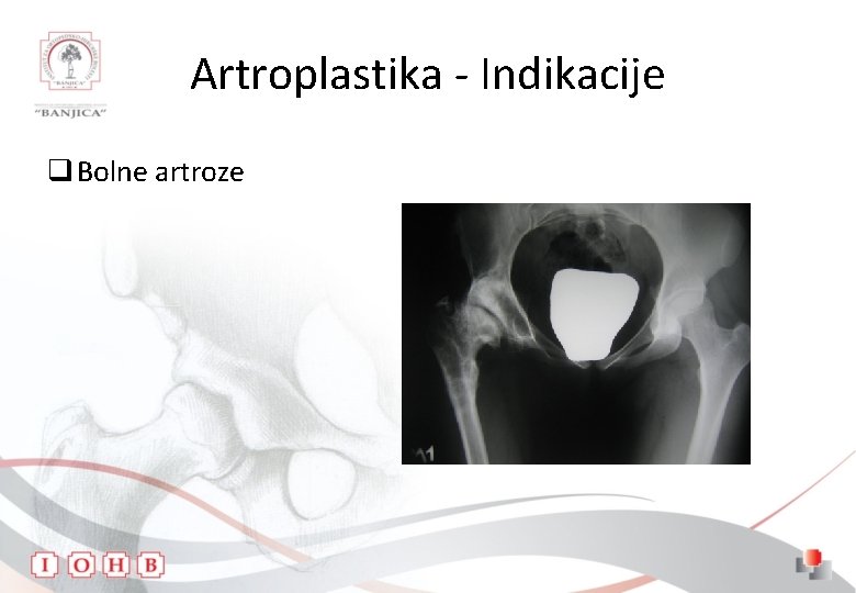 Artroplastika - Indikacije q Bolne artroze 