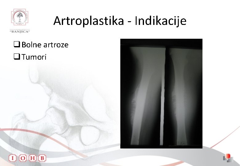 Artroplastika - Indikacije q Bolne artroze q Tumori 