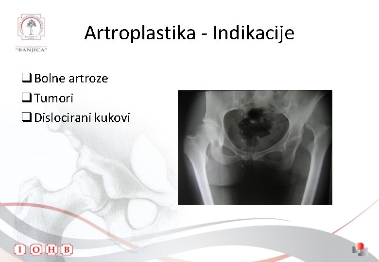 Artroplastika - Indikacije q Bolne artroze q Tumori q Dislocirani kukovi 