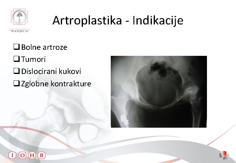 Artroplastika - Indikacije q Bolne artroze q Tumori q Dislocirani kukovi q Zglobne kontrakture