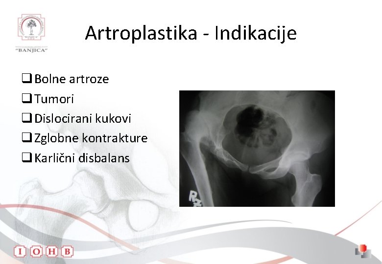 Artroplastika - Indikacije q Bolne artroze q Tumori q Dislocirani kukovi q Zglobne kontrakture