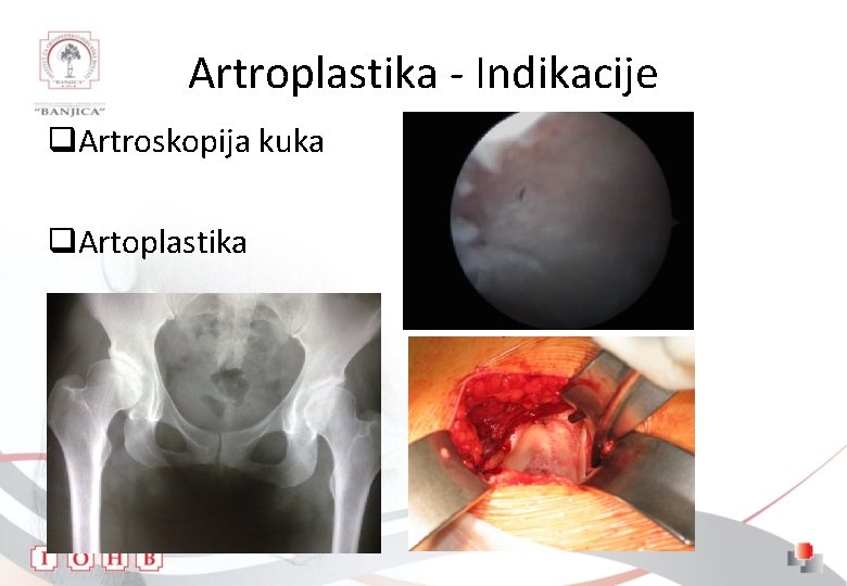 Artroplastika - Indikacije q. Artroskopija kuka q. Artoplastika 