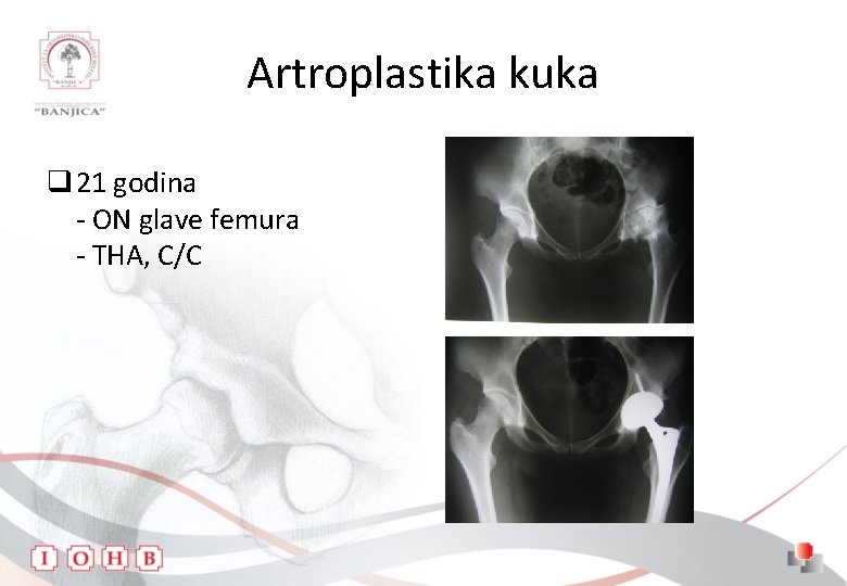 Artroplastika kuka q 21 godina - ON glave femura - THA, C/C 