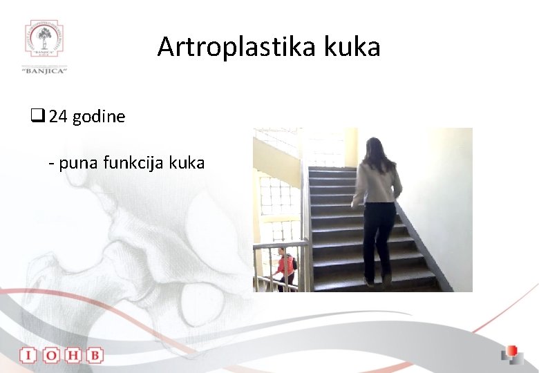 Artroplastika kuka q 24 godine - puna funkcija kuka 