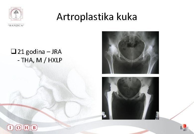 Artroplastika kuka q 21 godina – JRA - THA, M / HXLP 