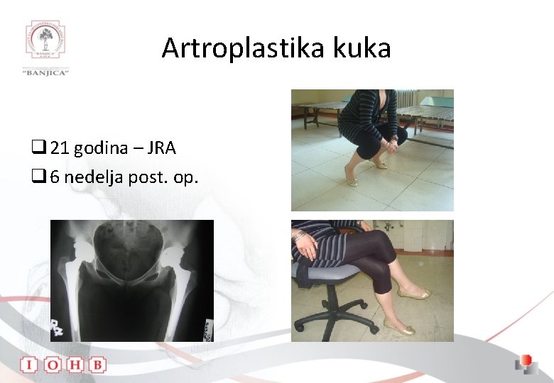 Artroplastika kuka q 21 godina – JRA q 6 nedelja post. op. 