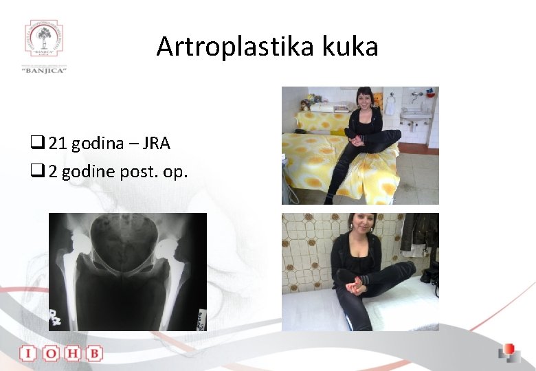 Artroplastika kuka q 21 godina – JRA q 2 godine post. op. 