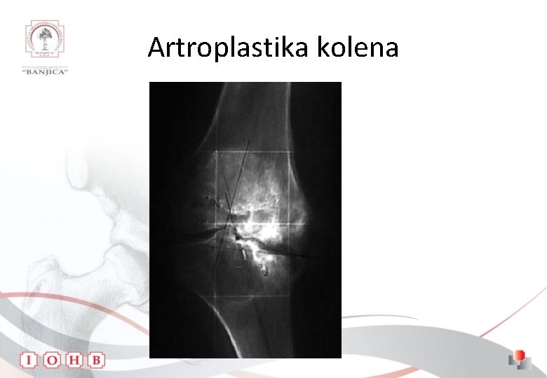 Artroplastika kolena 