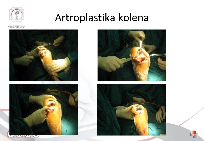 Artroplastika kolena 