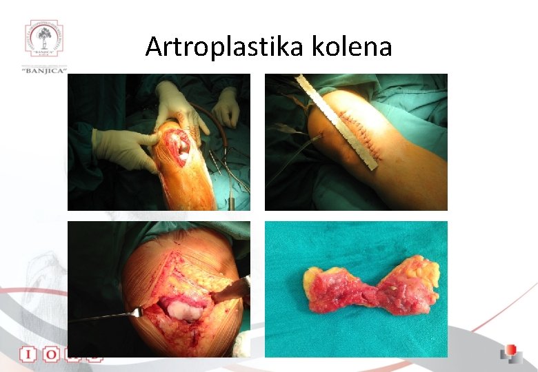 Artroplastika kolena 