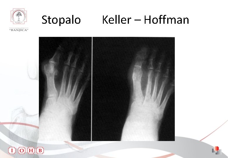 Stopalo Keller – Hoffman 