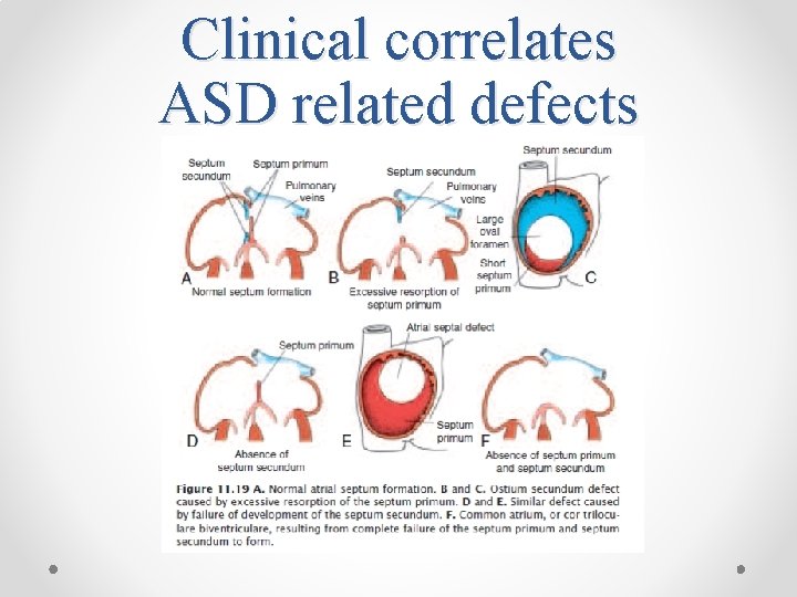 Clinical correlates ASD related defects 
