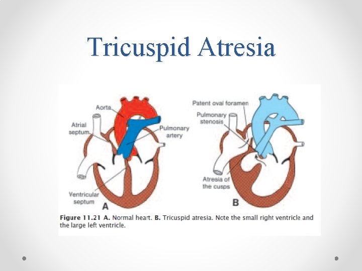 Tricuspid Atresia 