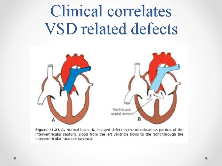Clinical correlates VSD related defects 