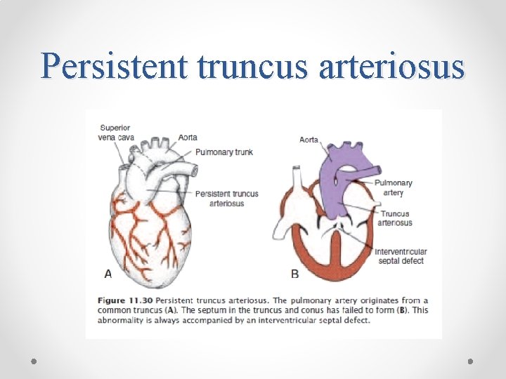 Persistent truncus arteriosus 