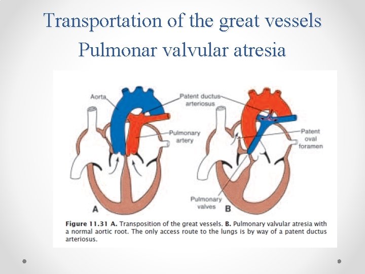 Transportation of the great vessels Pulmonar valvular atresia 