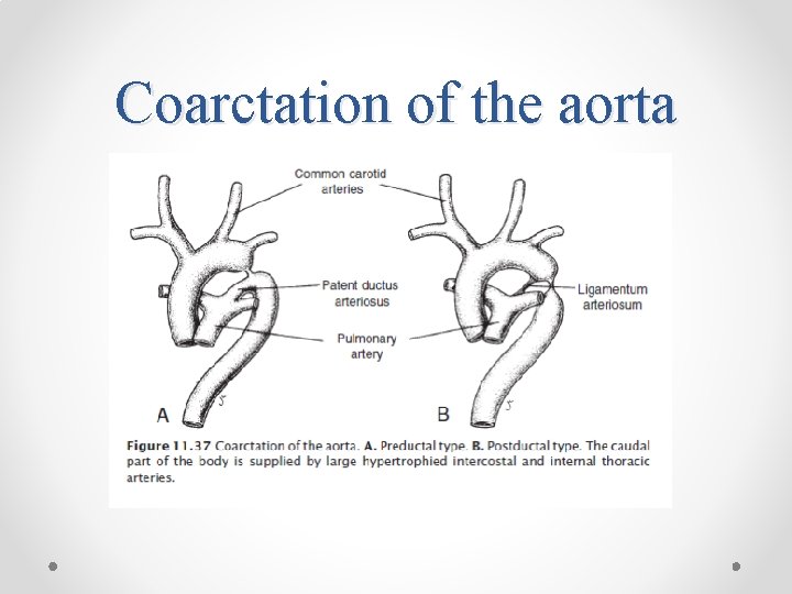 Coarctation of the aorta 