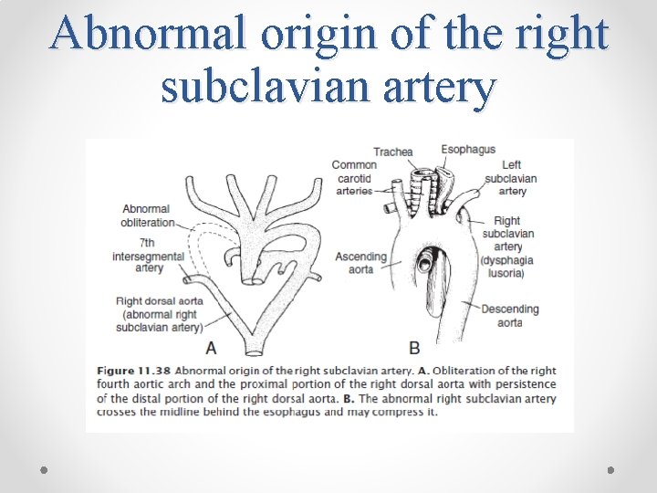 Abnormal origin of the right subclavian artery 