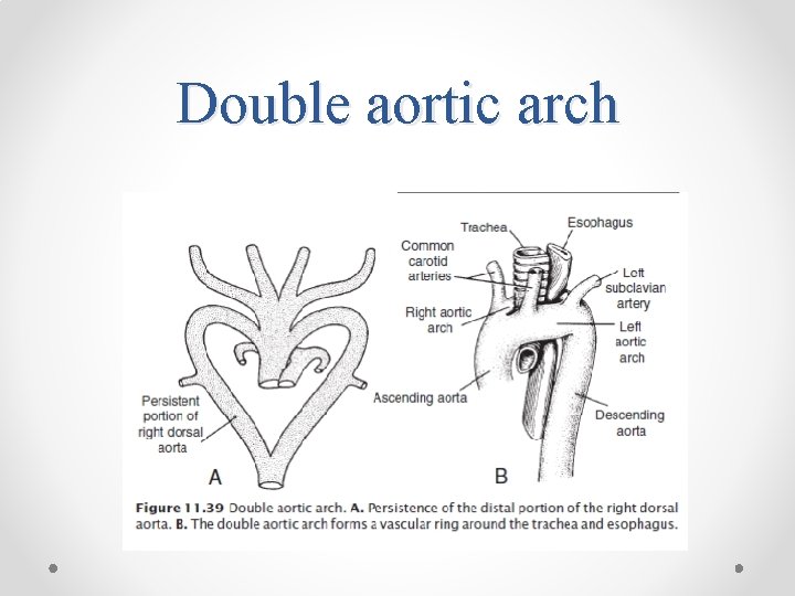 Double aortic arch 