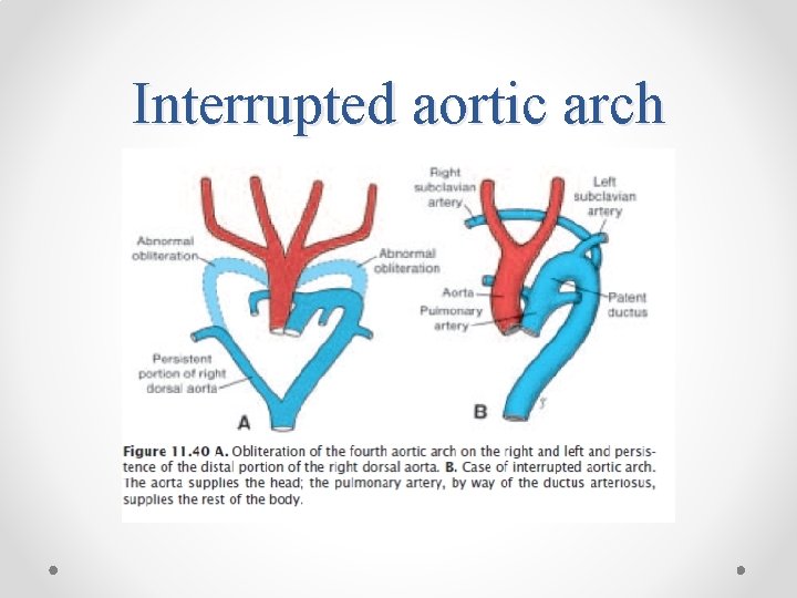 Interrupted aortic arch 