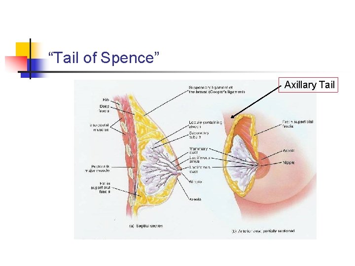 “Tail of Spence” Axillary Tail 