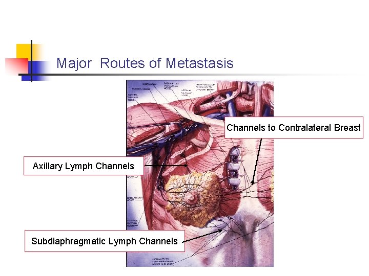 Major Routes of Metastasis Channels to Contralateral Breast Axillary Lymph Channels Subdiaphragmatic Lymph Channels